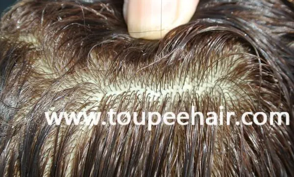 injection hair root